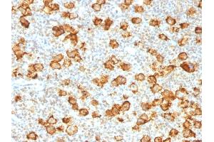 Formalin-fixed, paraffin-embedded human Hodgkin's Lymphoma stained with CD30 Rabbit Recombinant Monoclonal Antibody (Ki-1/1505R).