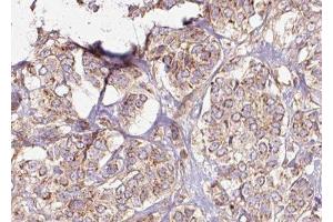 ABIN6275436 at 1/100 staining Human breast cancer tissue by IHC-P. (RAB3GAP2 Antikörper  (Internal Region))
