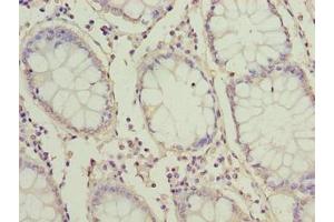 Immunohistochemistry of paraffin-embedded human colon cancer using ABIN7166380 at dilution of 1:100 (ZNF767P Antikörper  (AA 1-118))