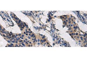 Immunohistochemistry of paraffin-embedded Human breast cancer tissue using COL17A1 Polyclonal Antibody at dilution of 1:50(x200) (COL17A1 Antikörper)