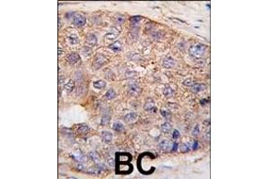 Formalin-fixed and paraffin-embedded human breast carcinoma tissue reacted with UBTD1 Antibody (C-term ) (ABIN387937 and ABIN2844471) , which was peroxidase-conjugated to the secondary antibody, followed by DAB staining. (UBTD1 Antikörper  (C-Term))