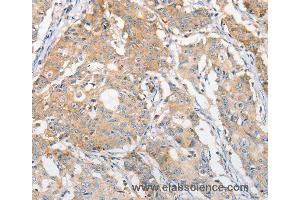 Immunohistochemistry of Human gastric cancer using APOBEC3G Polyclonal Antibody at dilution of 1:30