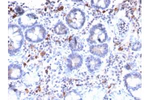 Formalin-fixed, paraffin-embedded human Gastric Carcinoma stained with MUC3 Rabbit Recombinant Monoclonal Antibody (MUC3/2992R). (Rekombinanter MUC3A Antikörper)