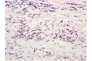 Formalin-fixed and paraffin embedded human rectal carcinoma labeled with Anti-ATF4/CREB-2 Polyclonal Antibody, Unconjugated (ABIN687862) at 1:200 followed by conjugation to the secondary antibody and DAB staining (ATF4 Antikörper  (AA 251-351))