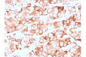 Formalin-fixed, paraffin-embedded human breast carcinoma stained with Prolactin Receptor Recombinant Mouse Monoclonal Antibody (rPRLR742).