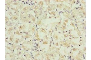 Immunohistochemistry of paraffin-embedded human gastric cancer using ABIN7162667 at dilution of 1:100 (PARD6B Antikörper  (AA 253-372))