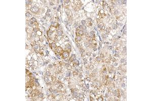 Immunohistochemistry of paraffin-embedded human liver cancer using Sterol carrier protein 2 Rabbit mAb (ABIN7270597) at dilution of 1:100 (40x lens). (SCP2 Antikörper)