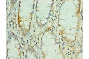 Immunohistochemistry of paraffin-embedded human colon cancer using ABIN7160505 at dilution of 1:100 (MEF2C Antikörper  (AA 170-380))