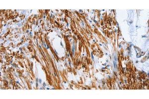 Immunohistochemistry of paraffin-embedded Human colon cancer tissue using SHROOM2 Polyclonal Antibody at dilution 1:50 (SHROOM2 Antikörper)