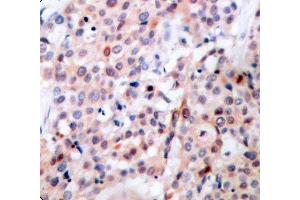 Immunohistochemistry (IHC) image for anti-B-Cell CLL/lymphoma 2 (BCL2) (pThr56) antibody (ABIN1681414) (Bcl-2 Antikörper  (pThr56))