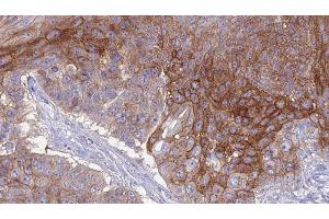 ABIN6276827 at 1/100 staining Human urothelial cancer tissue by IHC-P. (CEACAM1 Antikörper  (C-Term))