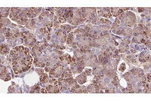 ABIN6273283 at 1/100 staining Human pancreas cancer tissue by IHC-P. (LEPREL2 Antikörper  (Internal Region))