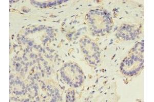 Immunohistochemistry of paraffin-embedded human breast cancer using ABIN7147264 at dilution of 1:100 (RAD17 Antikörper  (AA 1-270))