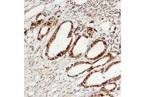 Immunohistochemical analysis of ERK3 staining in human breast cancer formalin fixed paraffin embedded tissue section. (MAPK6 Antikörper)