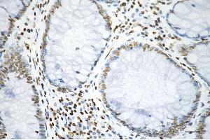 Immunohistochemistry was performed on paraffin-embedded human sigmoid colon carcinoma using histone H3 (acetyl K9) antibody (ABIN7798953), 1:200).