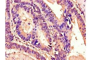 Immunohistochemistry of paraffin-embedded human colon cancer using ABIN7172930 at dilution of 1:100 (Tetraspanin 7 Antikörper  (AA 114-184))