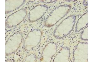 Immunohistochemistry of paraffin-embedded human colon cancer using ABIN7142126 at dilution of 1:100 (DPH2 Antikörper  (AA 1-489))