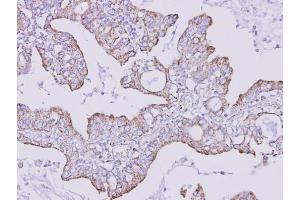 IHC-P Image Immunohistochemical analysis of paraffin-embedded human lung cancer, using FOXRED1, antibody at 1:300 dilution. (FOXRED1 Antikörper)