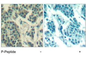 Immunohistochemical analysis of paraffin-embedded human breast carcinoma tissue using ERBB3 (phospho Y1328) polyclonal antibody . (ERBB3 Antikörper  (pTyr1328))