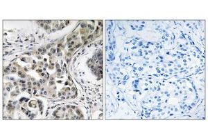 Immunohistochemistry analysis of paraffin-embedded human breast carcinoma tissue using USP6NL antibody. (USP6NL Antikörper  (Internal Region))