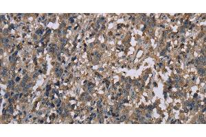Immunohistochemistry of paraffin-embedded Human liver cancer tissue using MCC Polyclonal Antibody at dilution 1:30 (MCC Antikörper)