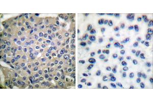 P-peptide - +Immunohistochemical analysis of paraffin-embedded human breast carcinoma tissue using Cortactin (phospho-Tyr466) antibody. (Cortactin Antikörper  (pTyr466))