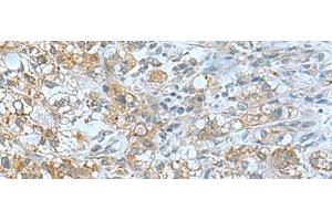 Immunohistochemistry of paraffin-embedded Human liver cancer tissue using TSGA10 Polyclonal Antibody at dilution of 1:50(x200) (TSGA10 Antikörper)