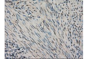 Immunohistochemical staining of paraffin-embedded Carcinoma of kidney tissue using anti-SLC18A2 mouse monoclonal antibody. (SLC18A2 Antikörper)