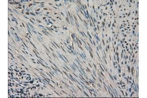 Immunohistochemical staining of paraffin-embedded Carcinoma of kidney tissue using anti-SLC18A2 mouse monoclonal antibody. (SLC18A2 Antikörper)