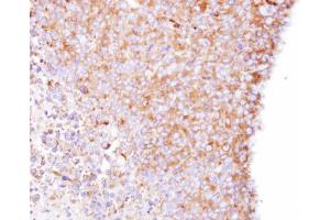 IHC-P Image Immunohistochemical analysis of paraffin-embedded H1299 xenograft , using Coronin-1B, antibody at 1:500 dilution. (CORO1B Antikörper)