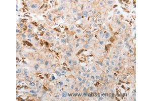 Immunohistochemistry of Human lung cancer using SLC15A2 Polyclonal Antibody at dilution of 1:60 (SLC15A2 Antikörper)