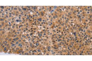 Immunohistochemistry of paraffin-embedded Human liver cancer tissue using NIF3L1 Polyclonal Antibody at dilution 1:30 (NIF3L1 Antikörper)