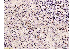 Formalin-fixed and paraffin embedded human cervical carcinoma labeled with Anti-HER2/NEU/ErbB2 Polyclonal Antibody, Unconjugated (ABIN725345) at 1:400 followed by conjugation to the secondary antibody and DAB staining (ErbB2/Her2 Antikörper  (AA 1210-1255))