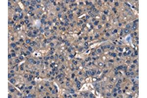 The image on the left is immunohistochemistry of paraffin-embedded Human liver cancer tissue using ABIN7129820(IGFBP5 Antibody) at dilution 1/25, on the right is treated with fusion protein. (IGFBP5 Antikörper)