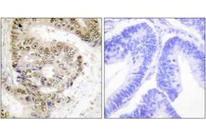 Immunohistochemistry analysis of paraffin-embedded human colon carcinoma tissue, using hnRNP L Antibody. (HNRNPL Antikörper  (AA 61-110))