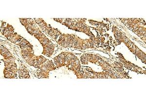 Immunohistochemistry of paraffin-embedded Human colorectal cancer tissue using ATP5PD Polyclonal Antibody at dilution of 1:50(x200) (ATP5H Antikörper)