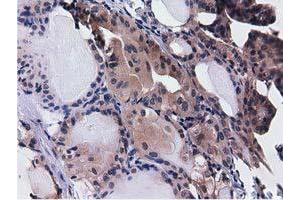 Immunohistochemical staining of paraffin-embedded Adenocarcinoma of Human ovary tissue using anti-CBWD1 mouse monoclonal antibody. (CBWD1 Antikörper)