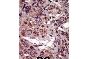 Formalin-fixed and paraffin-embedded human cancer tissue reacted with the primary antibody, which was peroxidase-conjugated to the secondary antibody, followed by AEC staining. (DGKA Antikörper  (C-Term))