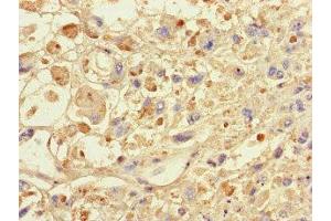 Immunohistochemistry of paraffin-embedded human melanoma using ABIN7146024 at dilution of 1:100 (SPAG9 Antikörper  (N-Term))