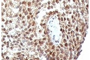Formalin-fixed, paraffin-embedded human colon carcinoma stained with anti-p53 antibody (SPM590)