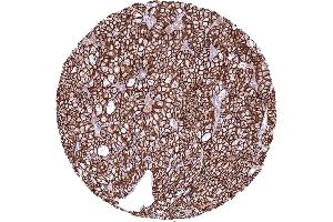 Kidney Chromophobe renal cell carcinoma with strong CDH16 immunostaining of tumor cells CDH16 immunohistochemistry (Rekombinanter Cadherin-16 Antikörper)