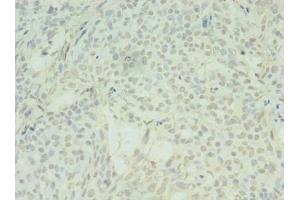 Immunohistochemistry of paraffin-embedded human breast cancer using ABIN7170902 at dilution of 1:100 (SDHC Antikörper  (AA 30-62))