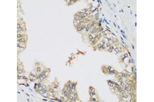 Immunohistochemistry of paraffin-embedded Human prostate using RRM1 Polyclonal Antibody at dilution of 1:200 (40x lens). (RRM1 Antikörper)