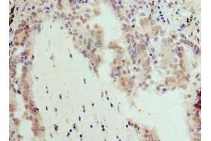 Immunohistochemistry of paraffin-embedded human lung cancer using ABIN7145816 at dilution of 1:100 (BRD7 Antikörper  (AA 601-651))