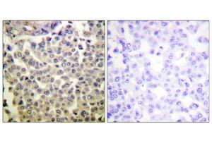 Immunohistochemistry analysis of paraffin-embedded human breast carcinoma tissue using PAK1/2/3 (Phospho-Thr423/402/421) antibody. (PAK1/2/3 Antikörper  (pThr402, pThr421, pThr423))