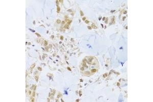 Immunohistochemistry of paraffin-embedded human breast cancer using MCM4 Antibody (ABIN5971548) at dilution of 1/100 (40x lens). (MCM4 Antikörper)