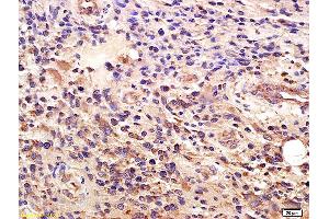 Formalin-fixed and paraffin embedded human glioma labeled with Anti-GLI1/ZFP5 Polyclonal Antibody, Unconjugated (ABIN673374) at 1:200 followed by conjugation to the secondary antibody and DAB staining.