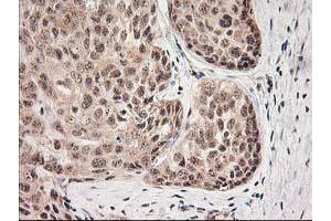 Immunohistochemical staining of paraffin-embedded Adenocarcinoma of Human breast tissue using anti-MGLL mouse monoclonal antibody. (MGLL Antikörper)