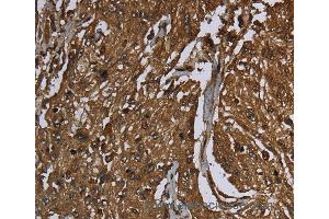 Immunohistochemistry of Human esophagus cancer using ARHGDIA Polyclonal Antibody at dilution of 1:50