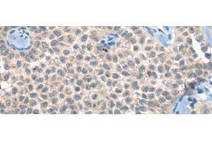 Immunohistochemistry of paraffin-embedded Human ovarian cancer tissue using CLTCL1 Polyclonal Antibody at dilution of 1:60(x200) (CLTCL1 Antikörper)